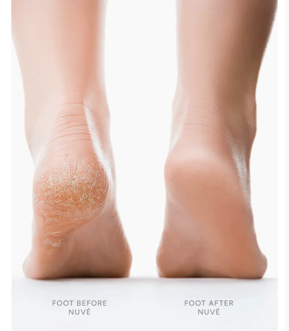 CallusRx Electric Roller